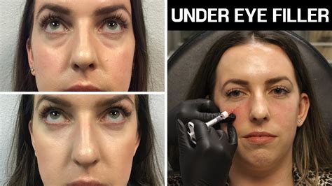 Restylane Under Eye Filler Before And After - All You Need Infos