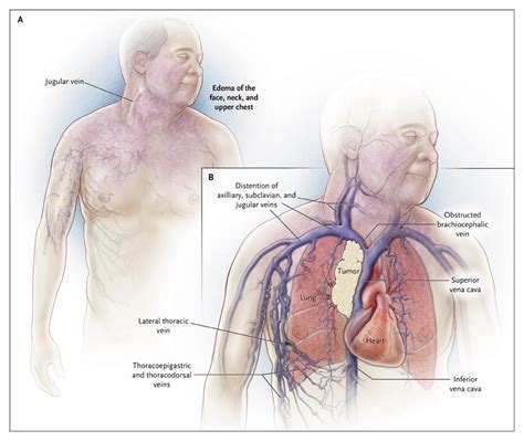 Superior Vena Cava Syndrome with Malignant Causes | NEJM