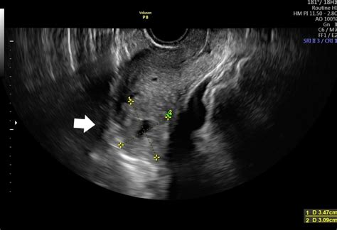 Cureus | Interstitial Pregnancy: Case Report of Atypical Ectopic Pregnancy