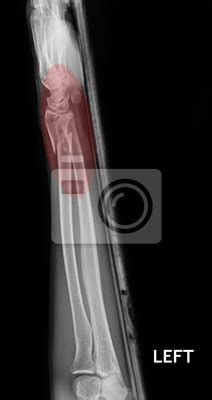 Fracture shaft of radius & ulnar bone, x-ray film wall mural • murals x-ray, x-ray, wrist ...