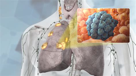 Stage 3 Lung Cancer : All that you need to know - Scientific Animations