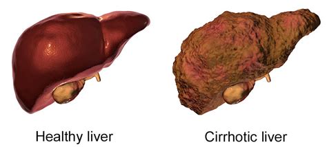 Cirrhosis of the liver | healthdirect