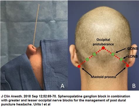 Occipital Nerve Block Technique | Images and Photos finder