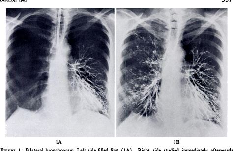 Figure 1 from Evaluation of a new contrast medium for bronchography. | Semantic Scholar