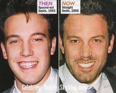 Celebrity Teeth, Celebrity Surgery, Celebrity Smiles, Celebrities With ...