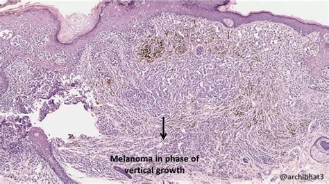 Pathology of Malignant Melanoma - Pathology Made Simple