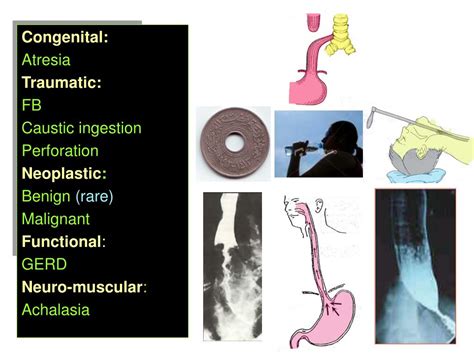 PPT - Diseases of the esophagus PowerPoint Presentation, free download - ID:1012308