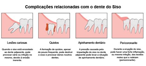 Imagens De Dente Siso Inflamado / Conhecidos popularmente como dente do juízo, geralmente são os ...