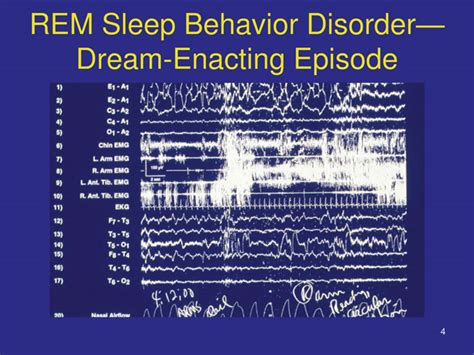 REM Sleep Behavior Disorder | Neupsy Key