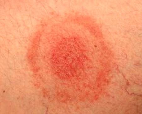 Tick Bite - Images, Rash Pictures, Symptoms, Causes, Treatment