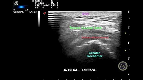 ULTRASOUND AND GREATER TROCHANTER PAIN SYNDROME - YouTube