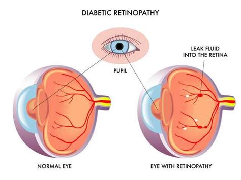 What Is Included In A Diabetic Eye Exam - DiabetesWalls