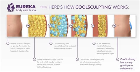 CoolSculpting – Fat Reduction – Eureka Body Care & Spa