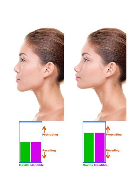 What forward growth of the maxilla and mandible looks like (even a pretty face can become ...