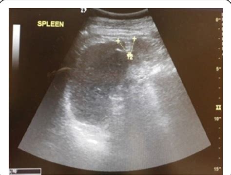 Scar of splenic infarction. | Download Scientific Diagram