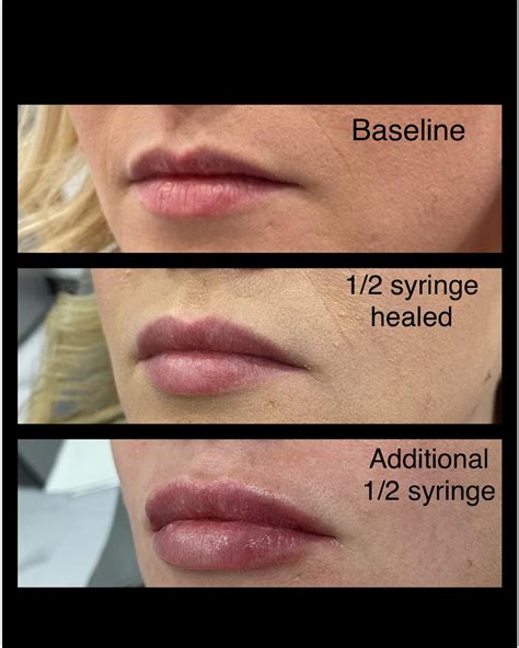 Lip Filler and Lip Flip - Skin Deep Aesthetics
