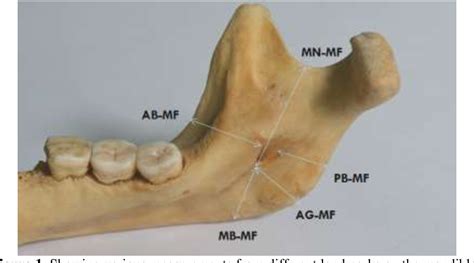 Figure 1 from A morphometric study of the mandibular foramen in dry adult human mandibles – A ...