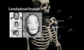 Craniodiaphyseal Dysplasia by Allison Lee on Prezi