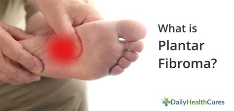 What is Plantar Fibroma and How is it Treated?