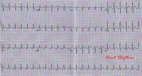 ECG Rhythms: Long RP tachycardia