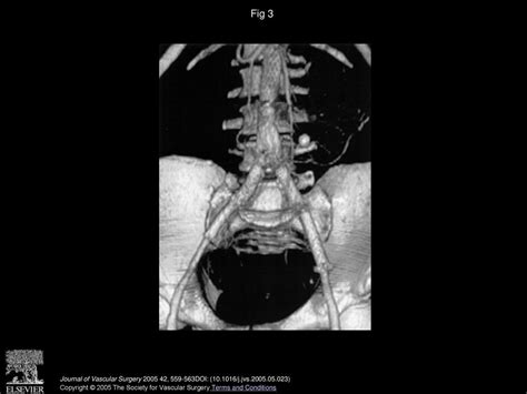 Hybrid treatment for juxtarenal aortic occlusion: Successful revascularization using iliofemoral ...