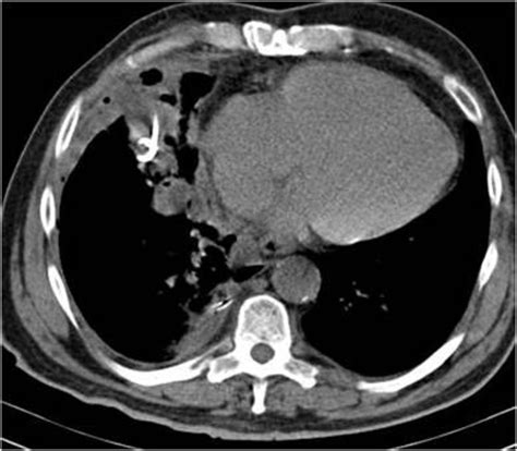 Ir Drainage Of Abscess