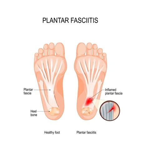 Plantar Fasciitis Pain Management - Propel Physiotherapy