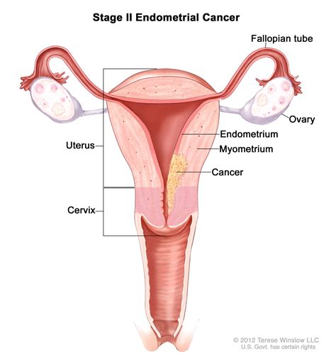 Endometrial Cancer Treatment - NCI