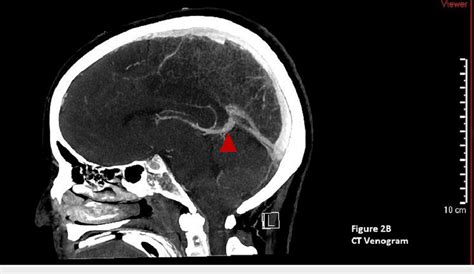 CT venogram of the head. The red triangle shows normal venous blood flow. | Download Scientific ...