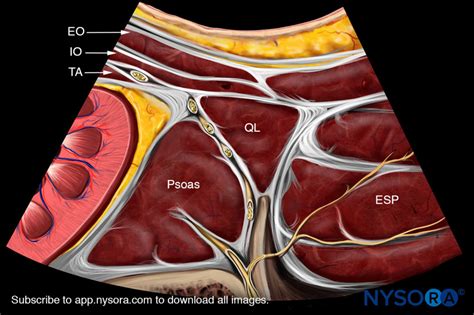 Quadratus Lumborum Block - NYSORA e-Learning System