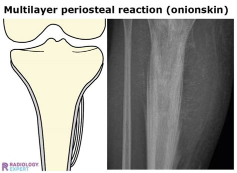 Bone tumours