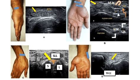 Flexor Tendons Wrist Ultrasound