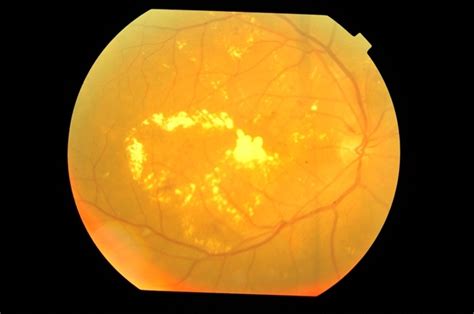 Exudative Diabetic Maculopathy - Retina Image Bank