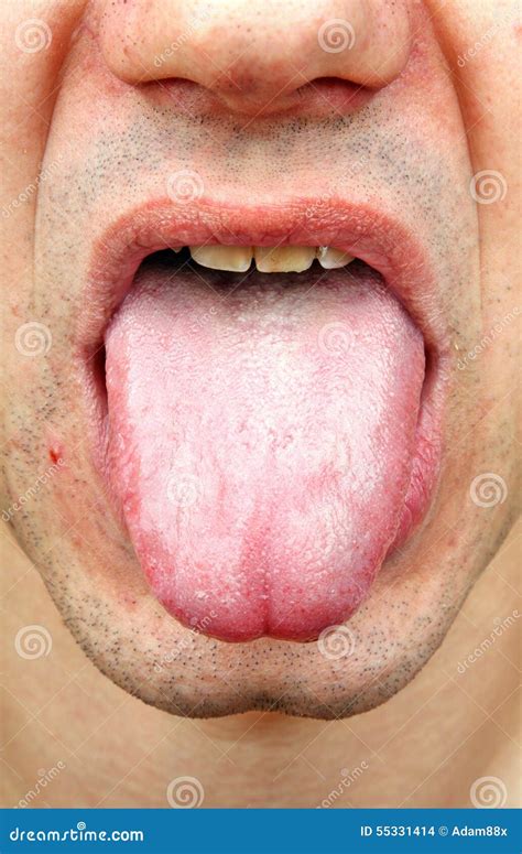 Bacterial Infection Disease Tongue Stock Photo - Image of inflammation ...