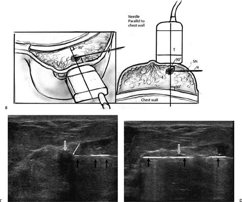 Breast Biopsy | Radiology Key