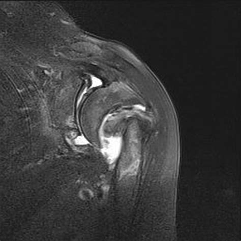 Proximal humerus fracture - wikidoc