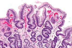 Reactive gastropathy - Libre Pathology