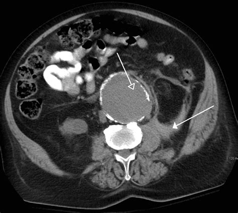 Ruptured Abdominal Aortic Aneurysm Ultrasound