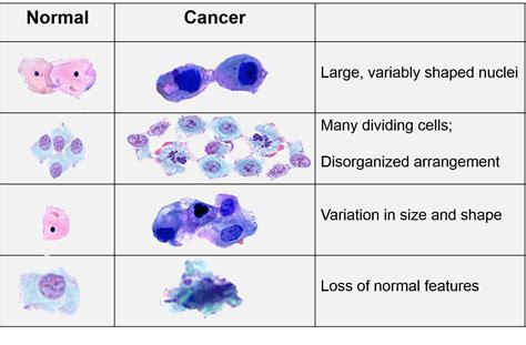 Sarcoma - Cooper Rice-Brading Foundation