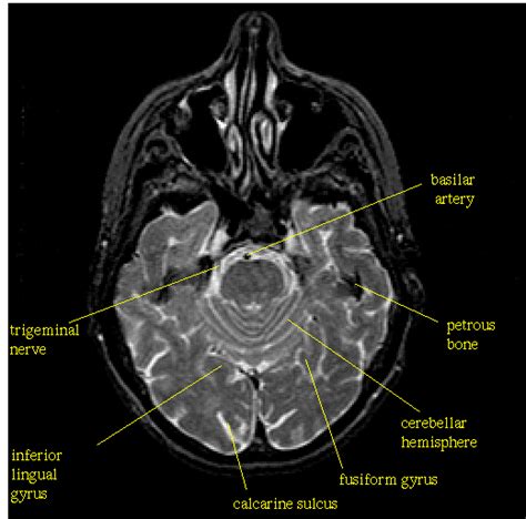 Trigeminal Nerve Mri Sagittal