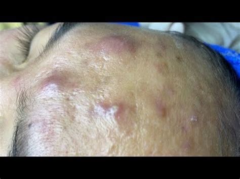 Satisfying Relaxing with Sac Dep Spa Video (#202) : r/popping