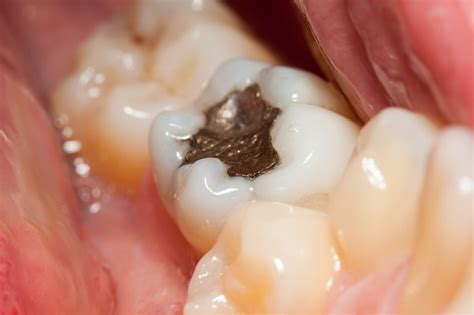 3 Signs that Your Dental Filling is Going Bad - Advanced Family ...