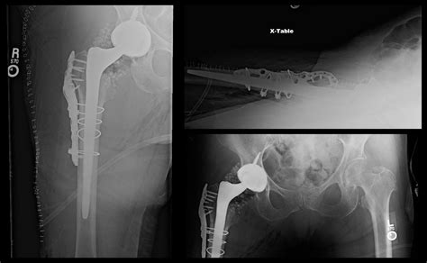 Periprosthetic Femur Fracture ORIF, Stem Revision