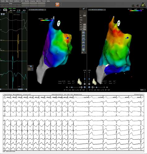 Inappropriate sinus tachycardia or…something else? - Muresan - 2019 ...