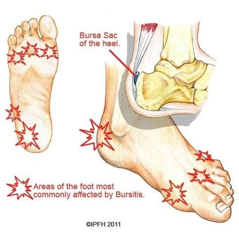 Bursitis - Advance Foot Clinic Podiatry