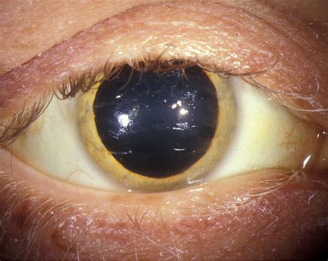 Kayser-Fleischer Ring: A Systems Based Review of the Ophthalmologist's Role in the Diagnosis of ...