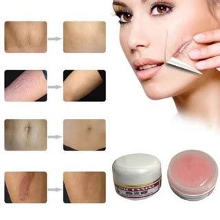 Keloid Scar Removal Cream | Shopee Singapore