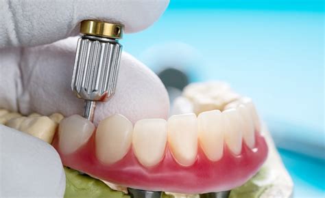 A Guide to Tooth-Supported Overdentures: Cost, Types, and Benefits