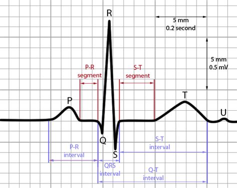 electrophysiology - What are the highest and lowest amplitude values in ECG for humans ...