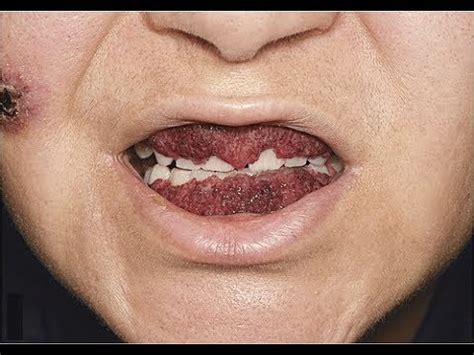 Rare Gum Condition (Strawberry Gingivitis) - YouTube